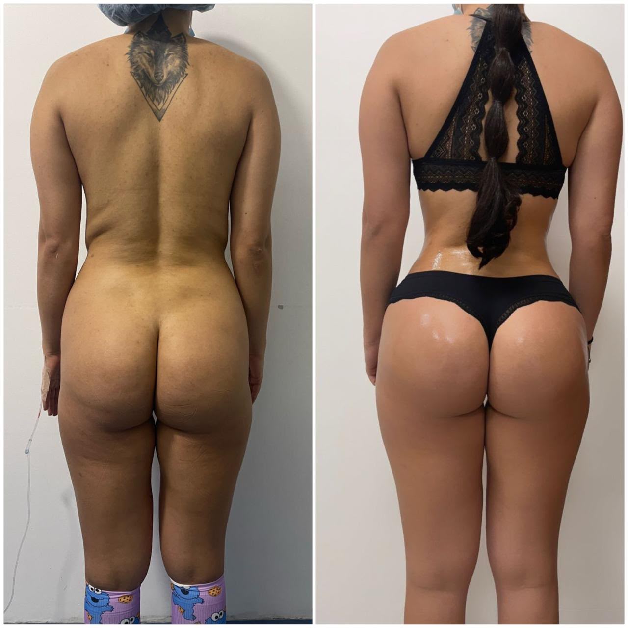 Antes y después — gluteoplastia