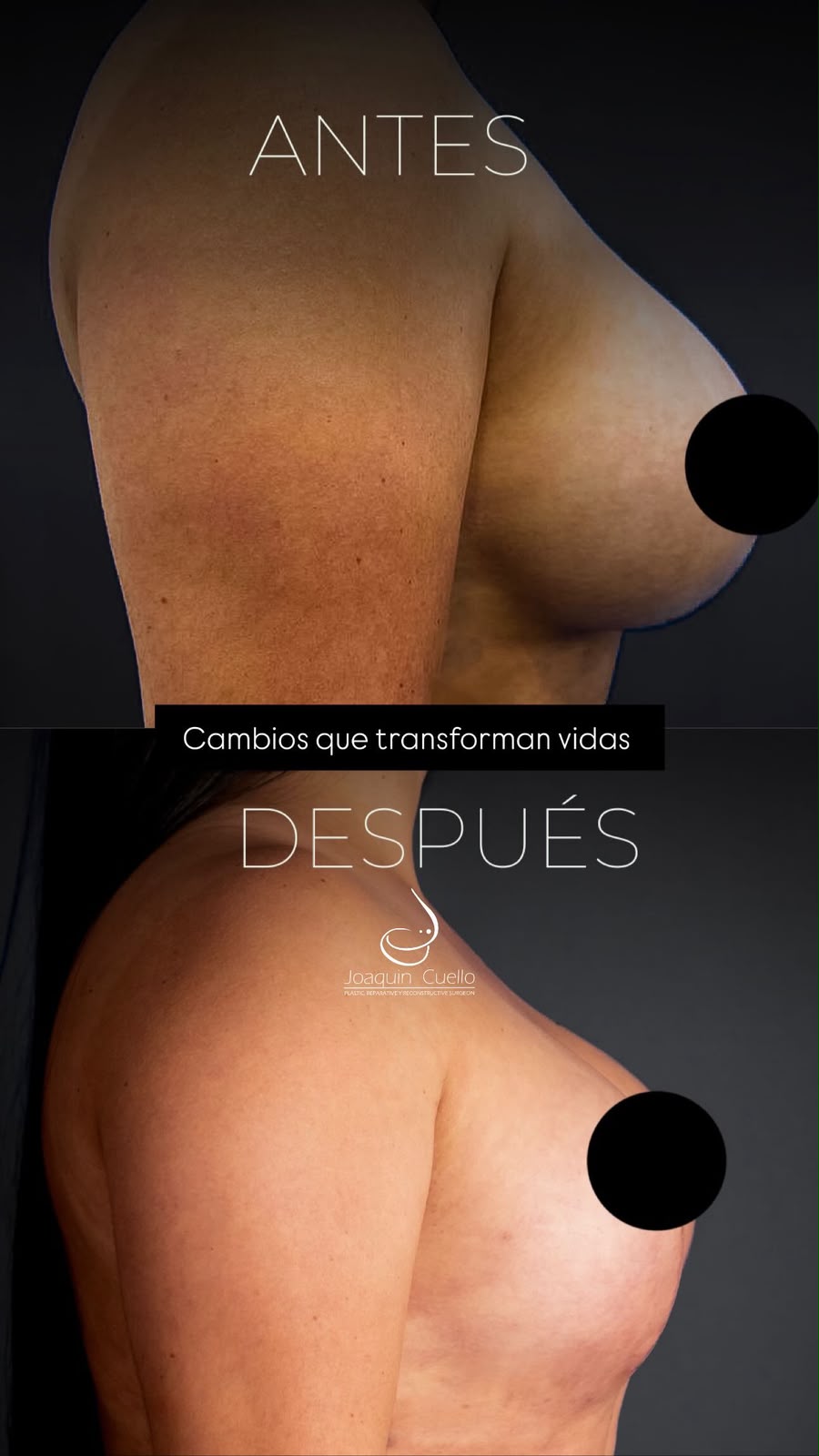 Antes y después — cirugía mamaria