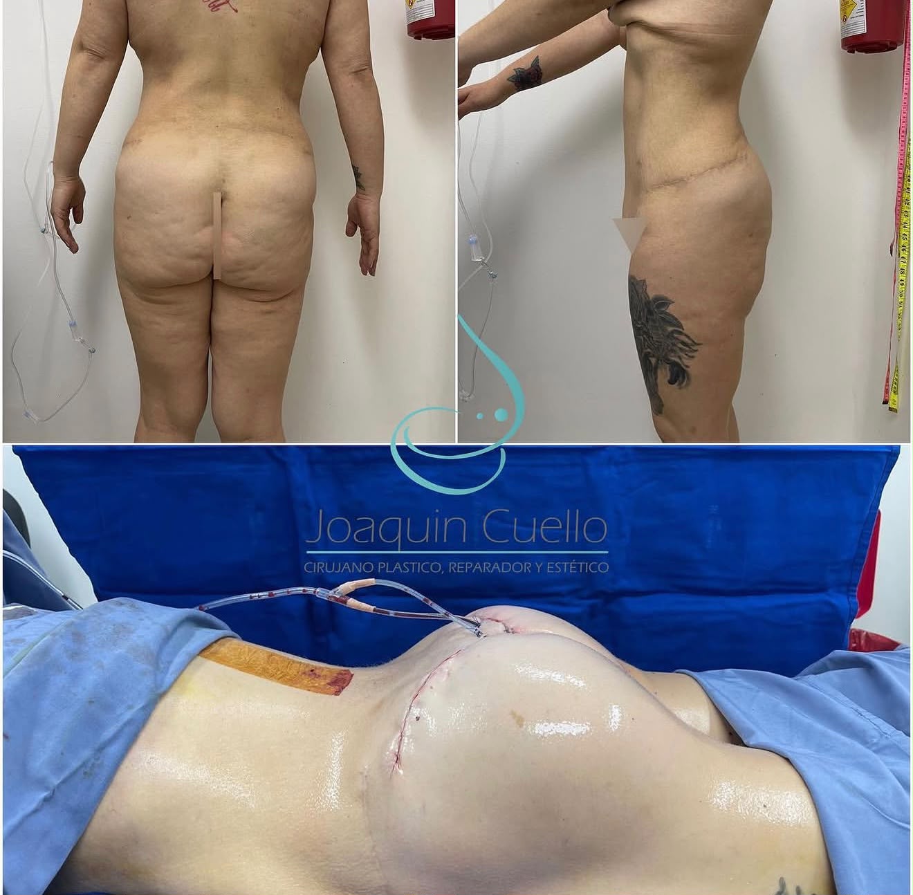 Antes y después — contorno corporal